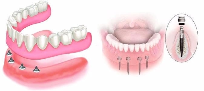 протезирование-зубов.jpg